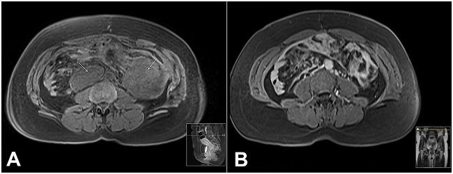 A - Abdominal magnetic resonance imaging (MRI) T1-weighted image, acquired in the axial plane, showing two new lesions (arrows); B - Abdominal MRI T1-weighted image, acquired in the axial plane, after chemotherapy, showing the regression of previous lesions.