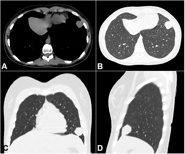 Thoracic computed tomography. A and B - Axial plane; C - coronal plane; D - sagittal plane showing a hyperattenuating juxtapleural lesion in the anterior segment of the left lower pulmonary lobe.