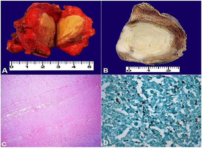 A - Gross aspect showing necrotic nodule. B - Formalin-fixed specimen which highlights concentric lines and a fibrous capsule. C - Photomicrography showing concentric necrotic lines (H&E 100X). D - Yeast forms of Histoplasma capsulatum (Grocott, 1000X).