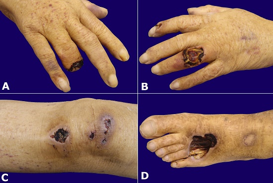 Gross examination of the distal right ring-finger after amputation (A) and necrotic skin ulcers; B – Left ring finger; C – Left knee; D – left foot.