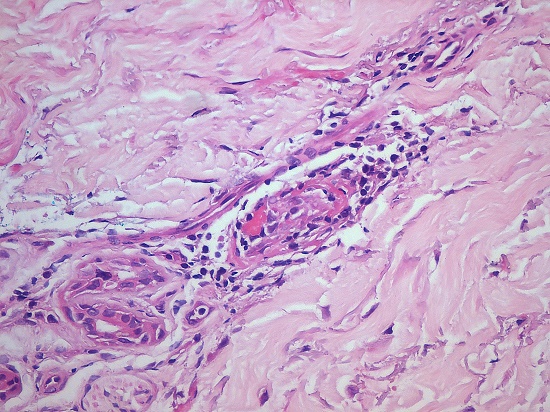 Photomicrograph of the skin biopsy showing mild lymphomononuclear pericapillary infiltrate with fibrinoid necrosis close to skin adnexa (H&E, 400X).