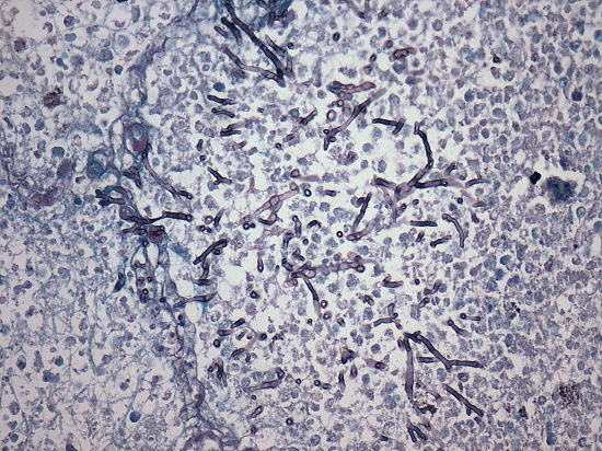 Photomicrograph of an area of aspiration pneumonia in the lung showing pseudohyphae of Candida spp. (Grocott, 400X).
