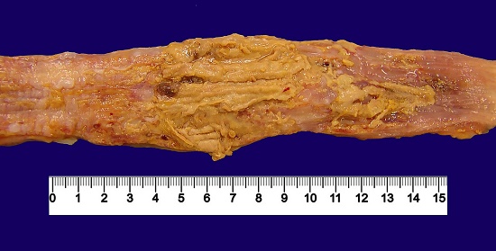 Gross view of the esophagus showing mucosa with loosely adherent grayish pseudomembranes.
