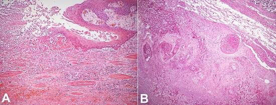 A – Photomicrograph of the esophagus showing an active ulcer with inflammatory exudate (H&E, 100X); B – Coagulative necrosis of esophageal submucosa and vessels (H&E, 100X).