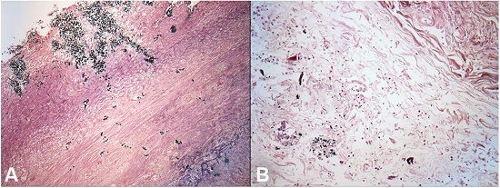 Photomicrograph of the esophagus showing invasive Candida spp. from mucosal ulcer and submucosa in A (Grocott; 100X) through adventitia; in B (yeasts in left bottom) (Grocott; 200X).
