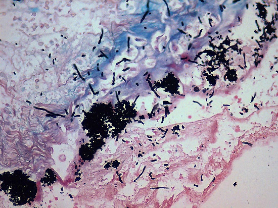 Photomicrograph of the peritoneum with exudative inflammation, pseudohyphae, and spores of Candida spp. (Grocott, 400x).