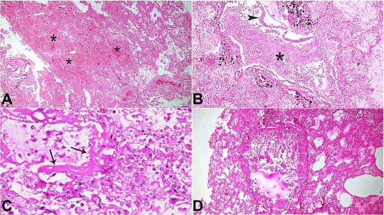 Photomicrograph of the lung. A – A massive intra-alveolar hemorrhage (asterisk) (H&E, 40X); B – Desquamation of bronchiolar epithelium (arrowhead) and necroinflammatory slough in the lumen (H&E, 100X) (asterisk); C – Presence of hyaline membrane (H&E, 400X) (arrows); D – The sloughing off of the bronchial epithelium (H&E, 100X).