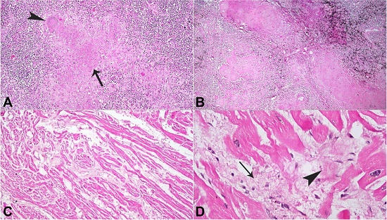 A and B – Photomicrograph of a carinal lymph node showing caseating granuloma (arrow) with a multinucleate giant cell (arrowhead) (H&E, 100X); C and D – Photomicrograph of the heart showing myofibril degeneration (arrowhead) and fibrosis (arrow) (H&E, 100X and 400X, respectively).