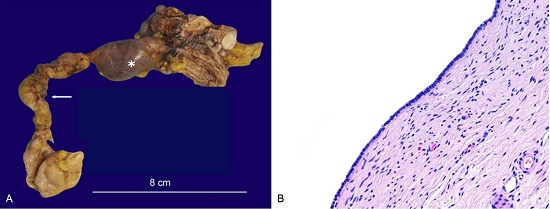 abdominopelvic CT. A – axial plane; B – Coronal plane – showing seminal vesicle cyst (arrow); C – axial plane; D – Coronal plane – showing left renal agenesis (asterisk).