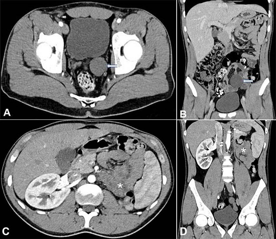 A – Gross view of the left seminal vesicle (arrow) and cyst (asterisk); B – Photomicrograph of the cystic wall lined by cuboidal epithelium without atypia and a mild lymphocytic infiltration of the cyst wall consistent with a seminal vesicle cyst (HE, 200x).