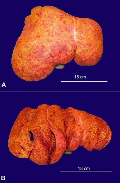 Gross view the liver. A &ndash; the outer surface is completely covered by small nodular lesions; B &ndash; multiple cross-sections showing the hepatic parenchyma completely occupied by yellowish-white nodules, with an average diameter of 3-4 mm.