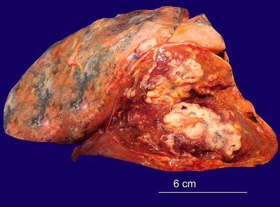 Gross view of lung tumor. A whitish 5.5 cm nodule was found in the right lower lobe, with peribronchial growth.