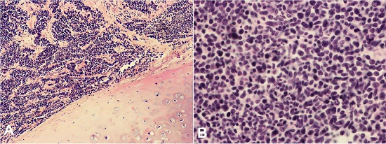 Photomicrographs of the lung neoplasm (A &ndash; H&E, 40X; B &ndash; H&E, 200X). The lesion histology consisted of small, rounded to oval, tumor cells, diffusely overlapped with diffused growth, with granular chromatin, nucleolus absent.