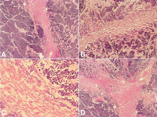 Photomicrographs of liver infiltrated by small cell lungs carcinoma (A &ndash; H&E, 40X; B &ndash; H&E, 100X; C &ndash; H&E, 200X; D &ndash; H&E, 40X). The liver was massively infiltrated by the lung neoplasm; only thin cords of hepatocytes remained.