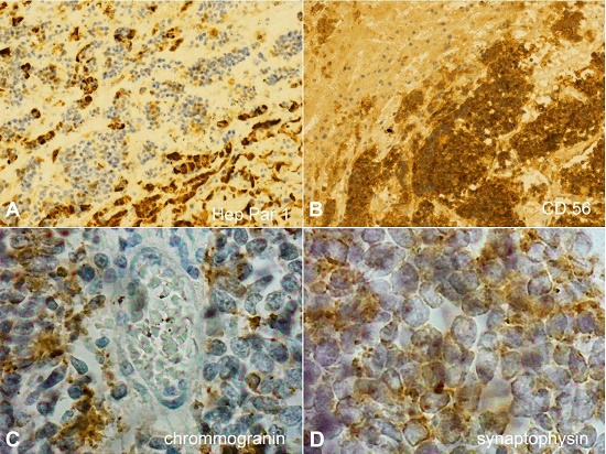 Photomicrographs of liver infiltrated by small cell lung carcinoma. A &ndash; the rare waves of residual hepatocytes are evident (Hep Par 1 immunohistochemical stain, 200X); B &ndash; the extensive aggregates of neoplastic cells that destroy the hepatic structure are evident (CD56 immunohistochemical stain 200X); C &ndash; faint positivitity for Chromogranin (200X); D &ndash; faint positivitity for Synaptophysin (400X).