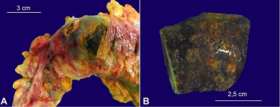 A &ndash; Gross view of the impacted stone in the sigmoid colon; B &ndash; Cylindrical surface of the stone from the sigmoid colon.
