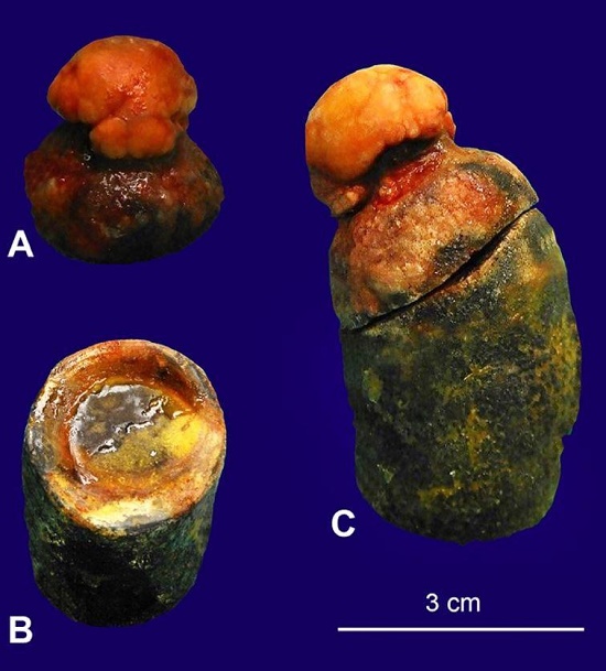 Gross view of the stones. A &ndash; Stone from the gallbladder; B &ndash; Fracture surface of the stone; C &ndash; Entire stone.