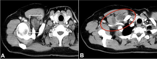 Thoracic CT – Axial plane showing a bilobed cystic lesion within the pectoralis minor muscle, which bulges the muscle contour from its insertion into the coracoid process
(A) and compresses the right subclavian vein to the outlet of the costoclavicular space
(B).