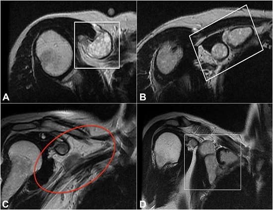 MRI T2 weighted images of the pectoral region showing a cystic tumor of 6.3 cm within the pectoralis minor muscle (
A and
B: axial plane;
C and
D: coronal plane). The lobed cyst
(D) presented a density with a very high signal in T2 weighted images (
A and
B).