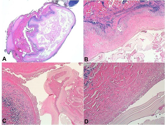 Photomicrograph of the lesion.
A – Panoramic view of the encapsulated cystic lesion containing a hydatid cyst cuticle (H&E, low power),
B – Cystic wall composed of fibrous tissue and inflammatory infiltrate. Inside, hydatid membranes (H&E, 4X).
C and D – Wall of the hydatid membranes. (H&E, 10X and 20X respectively).