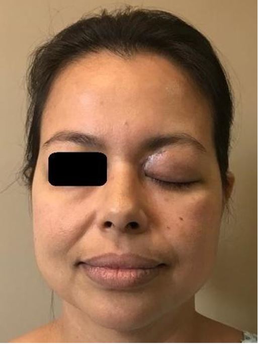 Involvement of the left orbit with edema, eyelid ptosis, purulent secretion and proptosis.