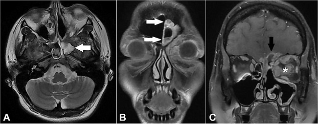 Resonance imaging of the orbital region. A, B, and C – signs of inflammatory sinusopathy on the left side (white arrows) associated on this side with heterogeneous infiltrative tissue orbitofacial (asterisk) extending to the skull base and intracranial (black arrow), with an image aspect compatible with the clinical diagnosis of a fungal process.