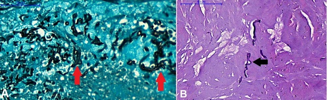 A – Grocott histochemical method, 400x magnification shows hyphae with diameters ranging from 1 to 5 μm and are hypo-septate (red arrows); B – Acid-Schiff histochemical method (PAS), 200x magnification. In some areas, the presence of irregular bifurcations (branching) that form 90-degree angles (black arrow) can be noted. A-B – The set of morphological findings suggests mucormycosis infection.