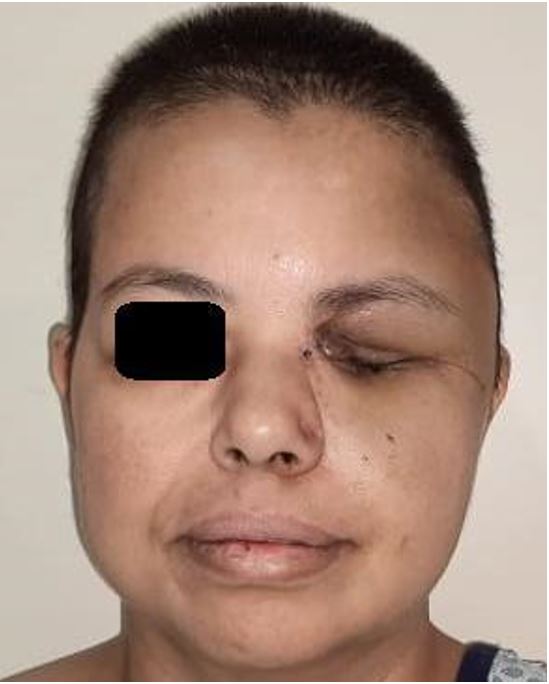 Patient’s face one month after the main surgery.