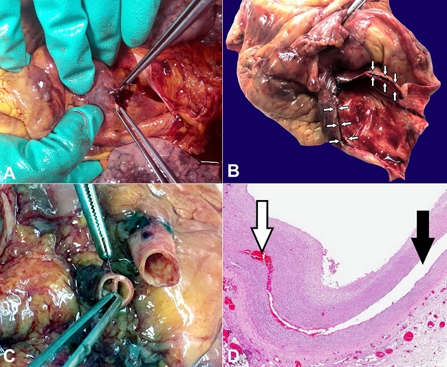 A – On opening the pericardium, after removing a large blood clot, perforation of the intrapericardial aorta is identified; B – After removing the heart, the sloughed aortic wall is identified. At the opening of the aorta's emergence, the blood sequestration is found within the dissection plane (arrows); C – The first tracts of the supra-aortic arterial vessels also show wall dissection; D – Photomicrograph of the aortic wall dissection (black arrow), with blood interposition between the two layers (white arrow) (H&E, 2x).
