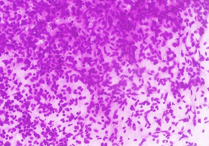 FNA cytology of Fetus in fetu showing small round blue cells and spindle-shaped cells (H&E, 100x).