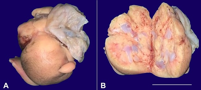 A and B &ndash; Resected fetiform mass covered with skin with cartilage on cut section with an attached membrane (scale bar 5 cm).