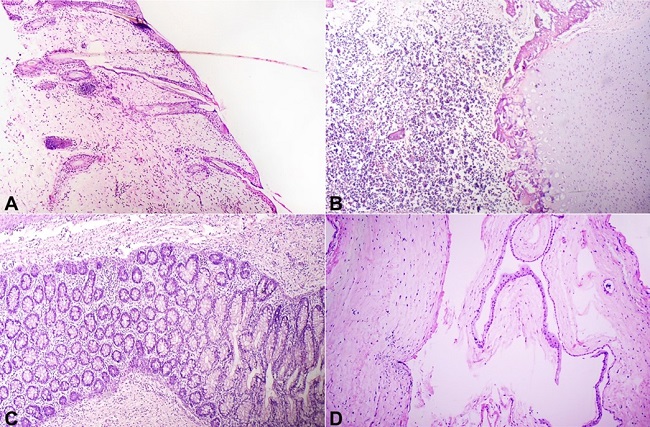 Photomicrographs of fetiform mass showing: A &ndash; skin with adnexa (H&E, 100x); B &ndash; structure resembling vertebra composed of bone marrow, cartilage, and bone (H&E; 100x); C &ndash; gut layer lined by colonic mucosa (H&E, 100x); D &ndash; structure resembling membrane showing chorion and amnion (H&E, 100x).