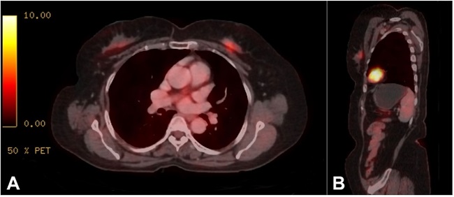 FDG-PET scan shows an ill-defined, hypermetabolic, heterogeneously enhancing FDG avid soft tissue nodular lesion involving upper inner quadrant of the left breast in axial view (Figure 1A) and parasagittal view (Figure 1B).