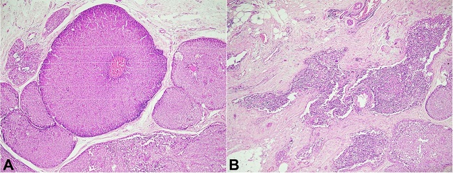 Photomicrograph of the tumor. A – reveal a tumor arranged in circumscribed large cellular nodules, closely apposed and expanded, separated by bands of fibrovascular stroma. The tumor cells are round to oval with moderate pleomorphism with a central vascular core (H&E, 400X); B – Shows foci of stromal invasion (H&E, 100X).
