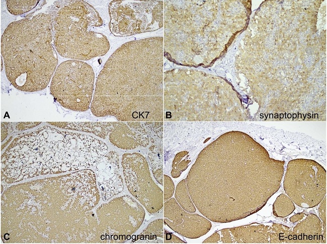 Photomicrographs of the tumor. Immunohistochemical panel. A – Strong immunoreactivity for cytokeratin (CK7, 40x); B – positivity to Synaptophysin (100x); C – positivity to chromogranin (40x); D – E-cadherin retained within the tumor cells (40x).
