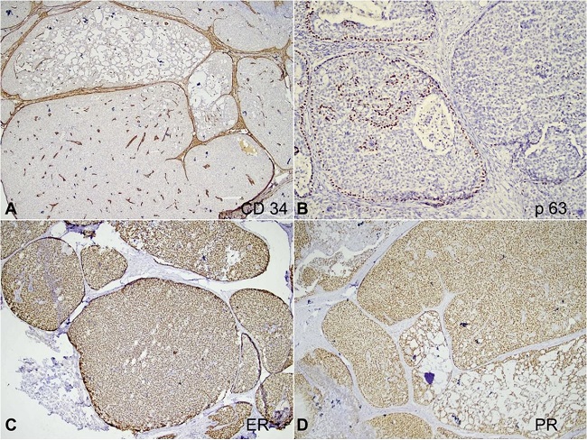 Photomicrographs of the tumor. Immunohistochemical panel. A – CD34 highlights the intermixed blood vessels within the tumor (40x); B – p63 shows focal loss of myoepithelial cells along the invasive foci (40x); C and D – Breast biomarker studies reveal immunopositivity for Estrogen Receptor (ER) (Allred score 8/8) and Progesterone Receptor (PR) (Allred score 8/8) respectively (40x).