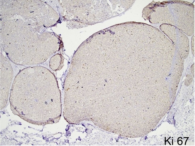 Photomicrographs of the tumor. Low to moderate Ki67 proliferation index of the tumor with 15-20% reactivity (40x).