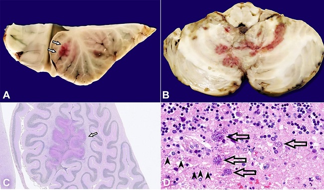 A &ndash; Cerebellar cutting (after formalin fixation): sagittal cut shows reddish friable area involving cerebellar folia (arrows); B &ndash; Axial cut shows reddish softened areas involving both cerebellar hemispheres and the cerebellar vermis; C &ndash; Microscopic view: at low magnification (Periodic Acid Schiff, magnification: 5x), a more intensely stained area is observed at the level of the cerebellar folia (arrow); D &ndash; Microscopic view: at higher magnification (H&E, magnification: 60x), this cerebellar area shows - at the transition between the granular layer and the molecular layer - the presence of necrosis and dark round corpuscles, consistent in size and morphology with Toxoplasma, both in the pseudocystic bradyzoite form (arrows) and in the dispersed/single tachyzoite form (arrowheads).