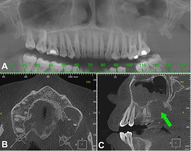 A – Panoramic reconstruction from computerized tomography, where the extension of the lesion can be evaluated better. Widening of the space occupied by the periodontal ligament around the first molar is also noted; B – Computerized tomography axial plane, showing an expansive hypodense tumor destroying the alveolar bone and expanding the maxillary cortical bone; C – Computerized tomography sagittal plane, showing an expansive hypodense tumor (arrow) invading the maxillary sinus.