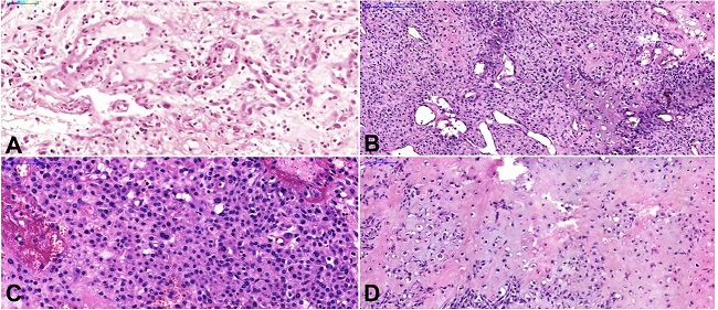 Photomicrographs of the lesion. A – Epithelioid cells, with eosinophilic cytoplasm and a small amount of eosinophilic matrix, in a very well-vascularized stroma could be seen in the first biopsy (H&E, Scale bar=50µm); B – The tumor, extremely vascularized, was composed of pleomorphic cells among the osteoid (upper left) or chondroid (bottom right) matrix (H&E, Scale bar=200µm); C – Round epithelioid cells with prominent cytoplasm and pleomorphic nuclei, sometimes multinucleated (H&E, scale bar=100µm); D – Chondroid and osteoid matrix are sometimes intermingled (H&E, scale bar=100µm). All the slides were digitized using a whole slide scanner (Pannoramic Desk, 3DHistech), with x20 objective.