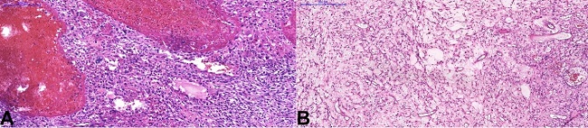 Photomicrographs of the lesion. A – Telangiectatic areas and pleomorphic spindle cells (H&E, scale bar=200µm); B – Highly vascularized myxoid areas. H&E, scale bar=500µm). All the slides were digitized using a whole slide scanner (Pannoramic Desk, 3DHistech), with x20 objective.