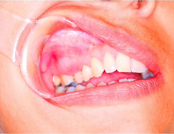 Clinical appearance of the lesion. Expansive mass in the right maxilla covered with normal-appearing oral mucosa.