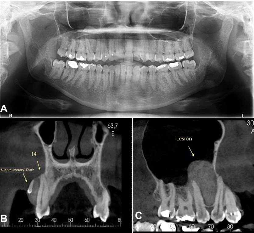 Imaging features of the lesion. A &ndash; Panoramic radiograph showing a unilocular lesion between the roots of right upper premolars and the presence of denticle-like mineralized material; B &ndash; Coronal view of cone-beam computed tomography (CBCT) image. Isodense lesion associated with upper right first premolar. Note the presence of a micro-tooth inside the tumor; C &ndash; Sagittal view of CBCT image. Isodense oval lesion in the right maxilla extending into the maxillary sinus and causing displacement of the roots of right upper premolars.