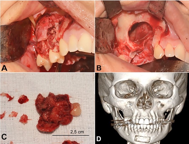 Intraoperative images and postoperative CT. A &ndash; Intraoperative view of the tumor involving buccal cortical bone in the region of upper right premolars and first molar; B &ndash; Intraoperative view of the bone cavity after curettage and removal of the involved teeth; C &ndash; Fragments of the surgical specimen sent for anatomopathological analysis; D &ndash; 3D-CT reconstruction image after repair of the maxillary defect.