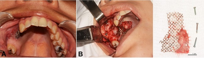 Intraoperative images after twelve months of the intraoral exposure of superficial titanium mesh. A &ndash; Intraoral view of superficial titanium mesh exposure. B &ndash; Intraoperative view of the superficial titanium mesh removal and titanium mesh and screws removed.