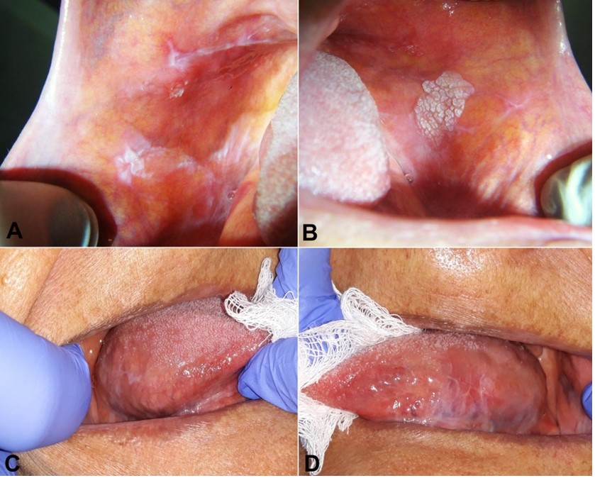 Clinical aspect of lesions clinically diagnosed as OLP and leukoplakia. A – white reticular lesions on the right buccal mucosa; B – white warty lesion on the left buccal mucosa adjacent to reticular lesions; C and D – white lesions on the right and left lateral borders of the tongue.