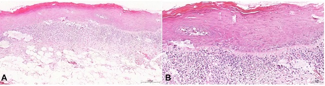 Microscopic characteristics of the OLP, lesion removed from the right buccal mucosa: A – lesion covered by stratified hyperortokeratinized squamous epithelium displaying a banded subepithelial inflammatory infiltrate (H&E, scale bar 50 µm; B – epithelial changes comprising exocytosis and spongiosis and predominantly lymphocytic connective tissue inflammatory infiltrate )H&E, scale bar 200 µm).