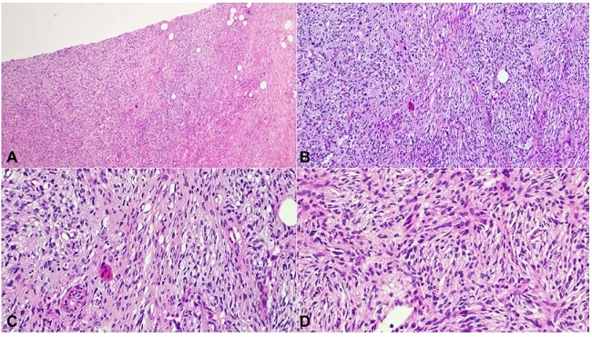 H&E sections showing areas of myoid differentiation in case 8. The myoid areas are diffuse and poorly demarcated. They are arranged in short fascicles. (A: 40x; B: 100x; C: 200x; D: 200x).