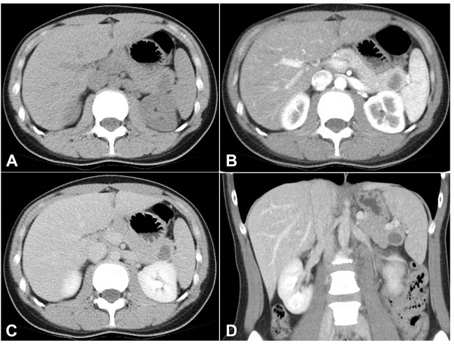 CT scan showed a hypodense and unilocular cyst in the tail of the pancreas, with no internal septation or calcification (A – plain, B – arterial phase, C – delayed phase, D – coronal section of delayed phase).