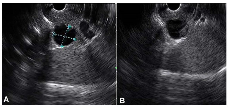 Endoscopic ultrasound with linear echoendoscope revealed a 1.6x1.5cm thinly septated cystic lesion at the pancreatic tail (A), with a suspicious 5mm mural nodule (B).